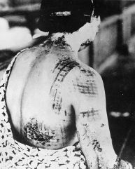 Un pacient japonez care suferă de sindromul radiaţiilor acute - tiparul kimono-ului s-a imprimat pe piele